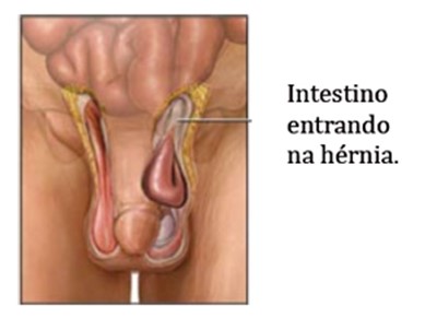 O que pode dar errado na Cirurgia de Hérnia Inguinal? • Café Cirúrgico